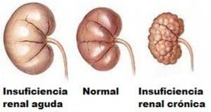 Acidosis por tóxicos Alcohol Metanol (formato) Etilenglicol (oxalato) Paraldehído (acetato, cloracetato) Salicilatos