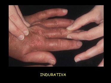 Fase Indurativa