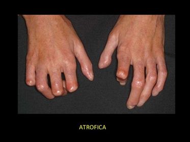Fase Atrofica