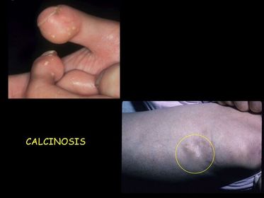 Calcinosis