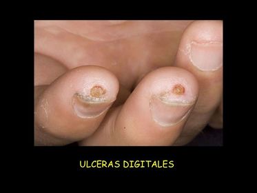 Ulceras Digitales (mordeduras de ratas)