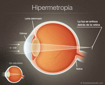 Defecto de la visión consistente en percibir confusamente los objetos próximos por formarse la imagen detrás de la retina.