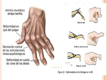 Artritis Reumatoidea