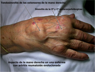 Manifestaciones Articulares Imagen 3 Tendosinovitis