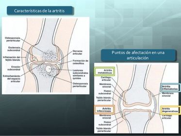 Esquema de cambios a nivel articular
