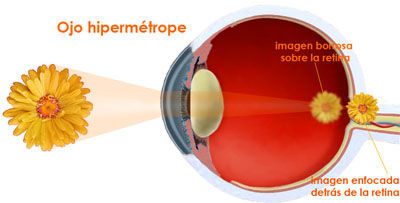 Defecto de la visión consistente en percibir confusamente los objetos próximos por formarse la imagen detrás de la retina.