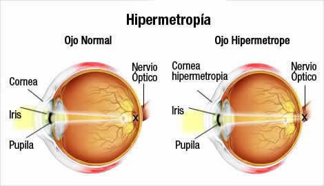 Defecto de la visión consistente en percibir confusamente los objetos próximos por formarse la imagen detrás de la retina