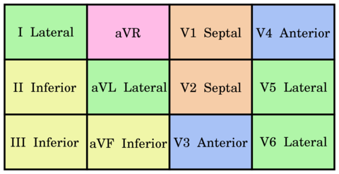 Masculino de 70 anios, con presencia del dolor precordial, de 45 minutos de duracion, nause, palidez, sudoracion, DIII, DIV y aVF. Que se...