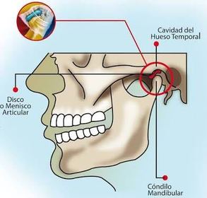 Condílea: Las superficies articulares, una cóncava y la otra convexa, son de forma elipsoidal, es una articulación biaxial con planos Sag...