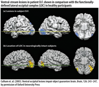 Ventral-stream lesions in patient with agnosia