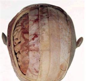 SNC - Medios de protección. Los medios de protección del SNC son: las meninges. el líquido cefalorraquídeo. el tejido adiposo. el...