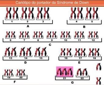 Sindrome de Down