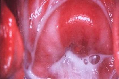 vaguinitis