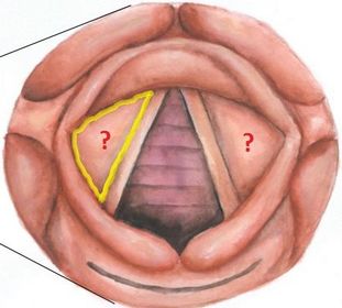 vestibular fold