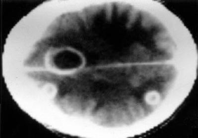 Infectología: Infecciones del sistema nervioso, Sepsis, Endocarditis, Tuberculosis, Partes blandas