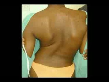 Cifoescoliosis