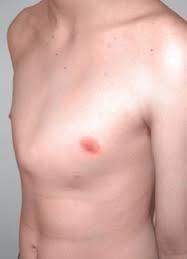 Pectum carinatum