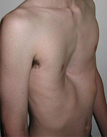 Pectum excavatum