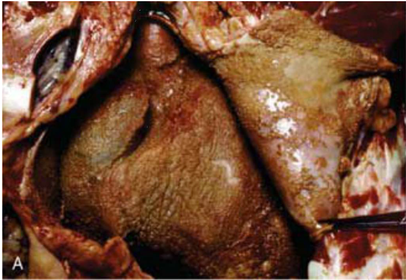 Inflamación y reparación. Capítulo 2 de Patología Humana de Robbins. Imágenes