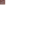 Inflamación purulenta con formación de abseceso. Múltiples abscesos bacterianos en los pulmones en un caso de bronconeumonía.