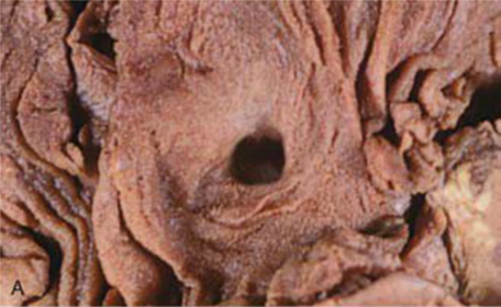 Úlcera duodenal crónica