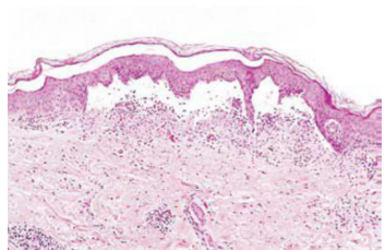 Inflamación serosa. Corte transversal de ampolla cutánea. Se reconce epidermis separada de la dermis a causa de un derrame seroso.
