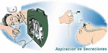 C) ASPIRACION DE SECRECIONES