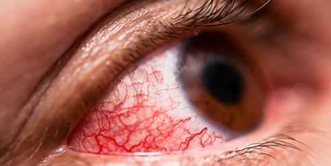 Ophthamology: Conditions Causing Acute Red Eye (Conjunctivitis, keratitis, Uveitis, Acute Glaucoma)
