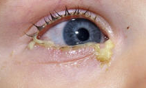 Bacterial conjunctivitis in a child with associated discharge