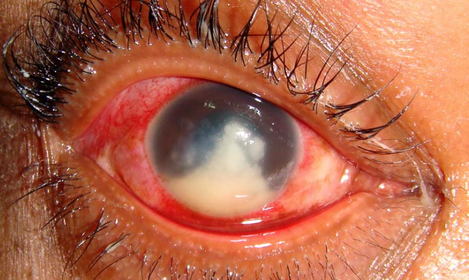 Severe keratitis due to a fungal infxn