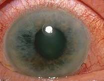 Acute angle-closure glaucoma. Hazy cornea & fixed mid-dilated pupil.