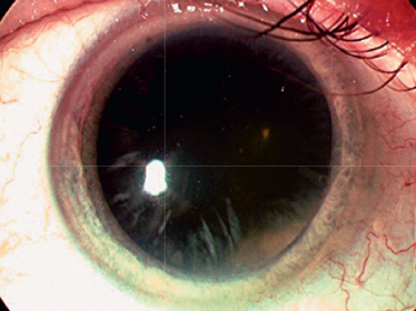 Ophthalmology: Conditions Causing Chronic Loss of Vision (Cataract, Chronic Glaucoma, Macular Degeneration, Diabetic Retinopathy)