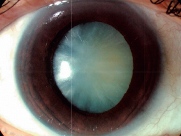 Late/mature cataract. K & C p1061.