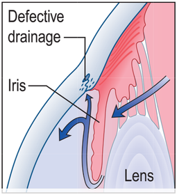 Primary open-angle glaucoma (POAG). Most common type. K & C p1061.