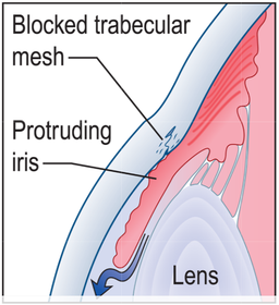 Angle-closure glaucoma. K & C p1061.