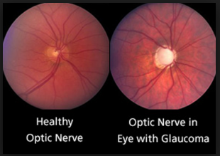 Cupping as seen in glaucoma.
