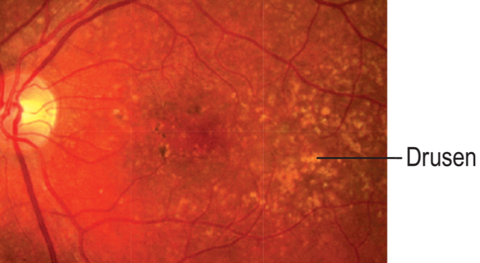 Drusen over the macula as seen in dry macular degeneration. K & C p1064.