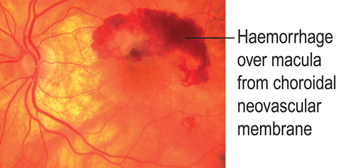 Sign seen in wet macular degeneration. K & C p1064.