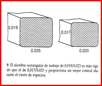 Los alambres de trabajo con forma rectangular pueden ser de 0,019/0,025; dan buen resultado durante la mecánica de deslizamiento y propor...