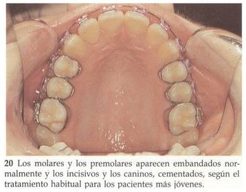 BANDAS Y CEMENTADOS