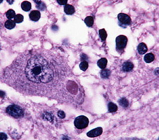Chlamydophila pneumoniae