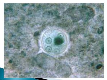 Entamoeba histolytica