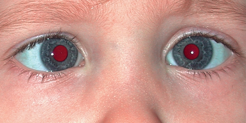 Paediatrics: Neurology and Development (Squint and Amblyopia)