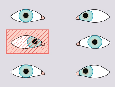 The cover test is used to identify a squint. If the fixing eye is covered, the squinting eye moves to take up fixation. This diagram show...