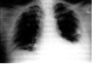 Diagnostico de P. aeruginosa por ventilacion mecanica