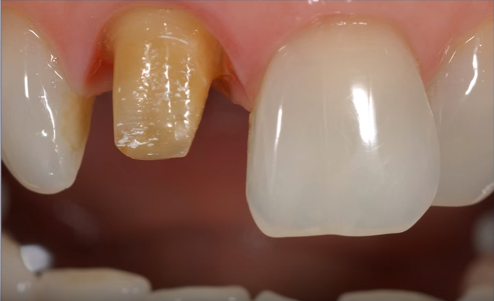 Tallado para prótesis fija en dientes anteriores.