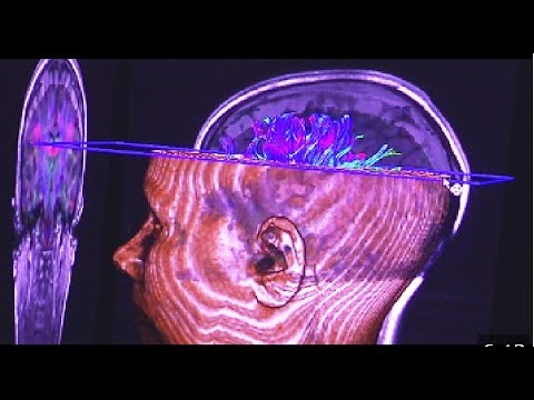 Esquizofrenia