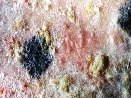VESÍCULA Lesión elevada y claramente circunscrita que se encuentra llena de líquido transparente y hasta 1 cm de diámetro