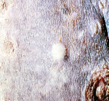 PÚSTULA Lesión pequeña, inferior a 1 cm, circunscrita y elevada que está llena de pus, de color amarillento a blanquecino. Las pústulas p...