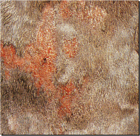EROSIÓN Un defecto epitelial poco profundo que no afecta la zona de la membrana basal de la epidermis y por lo tanto, cura sin cicatrices